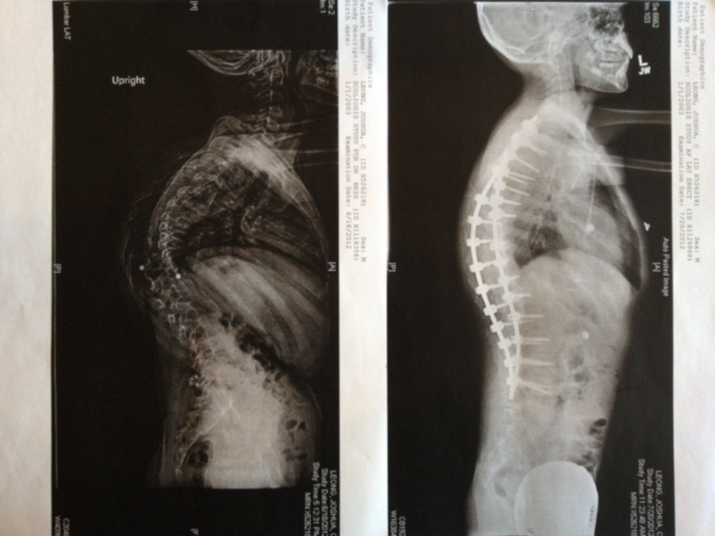 scoliosis3