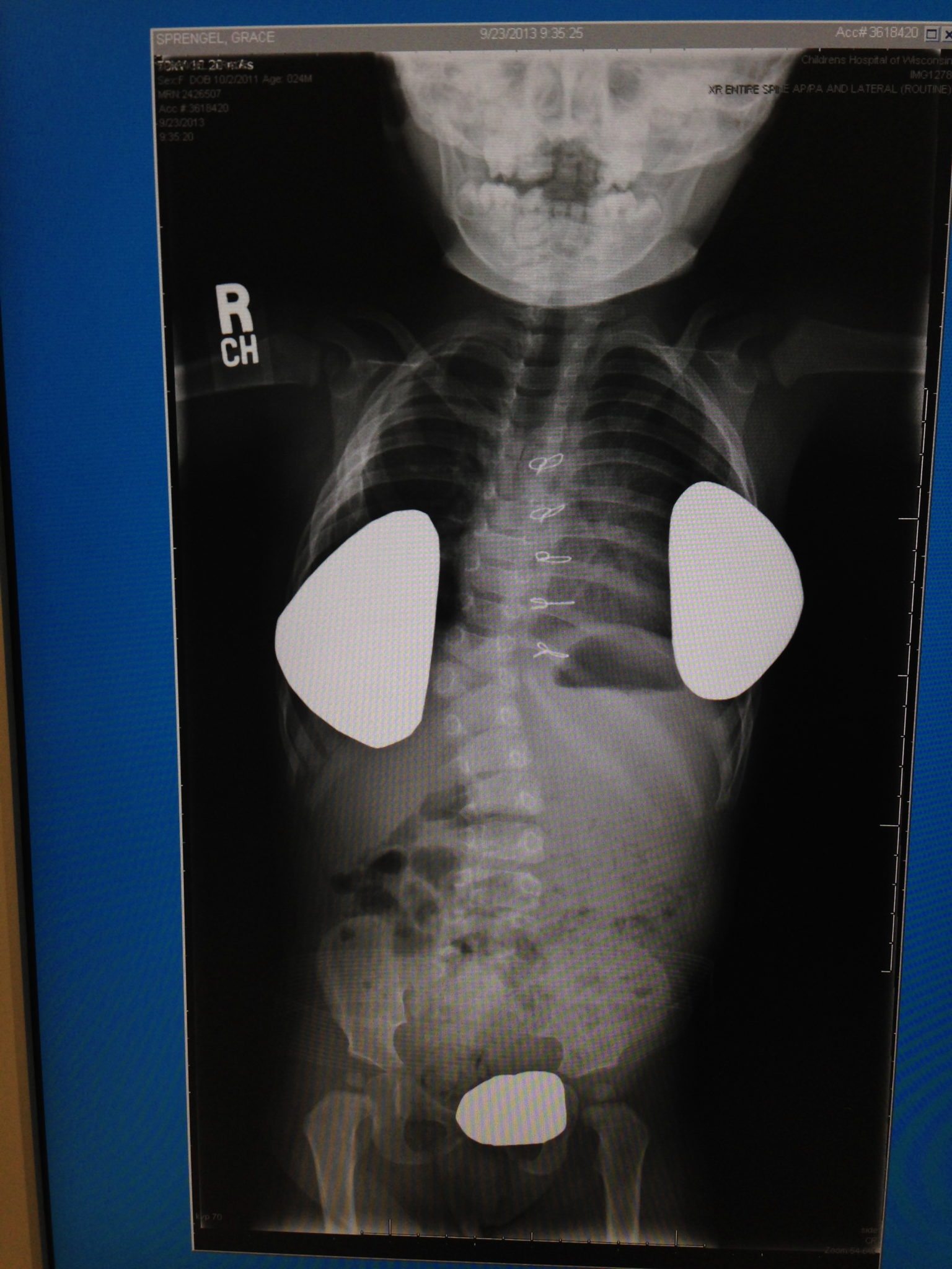 scoliosis